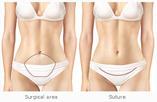 Mini-Tummy-tuck-abroad-Tunisia